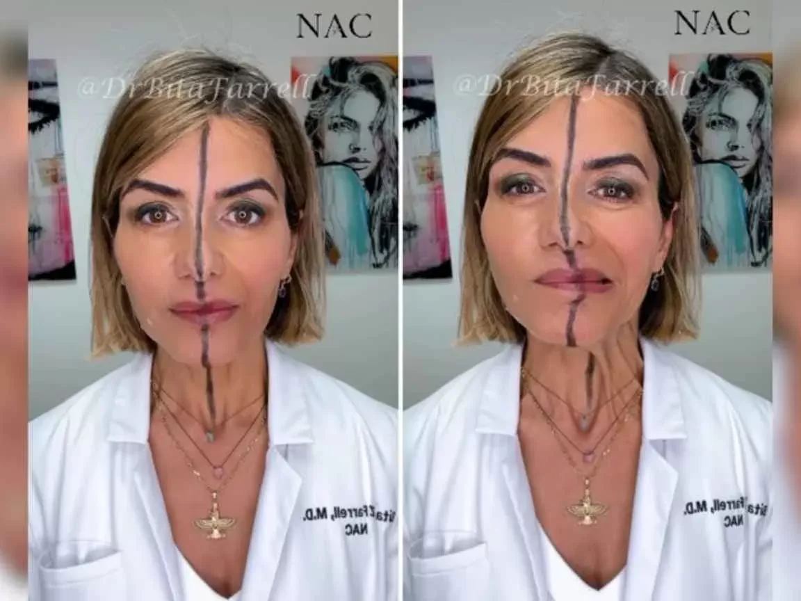 Médica aplica botox em apenas um lado do rosto e vídeo viraliza com resultado impressionante
