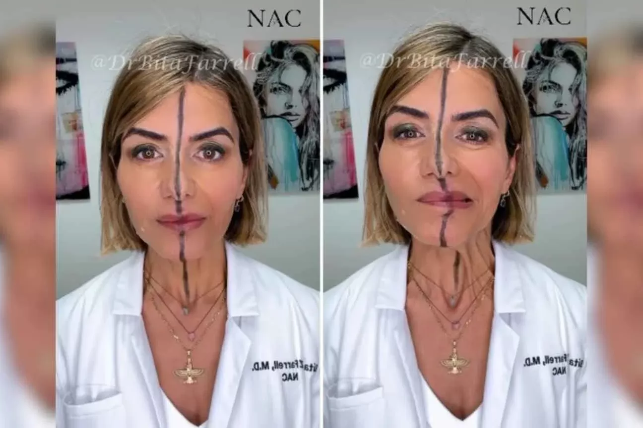 Médica aplica botox em apenas um lado do rosto e vídeo viraliza com resultado impressionante