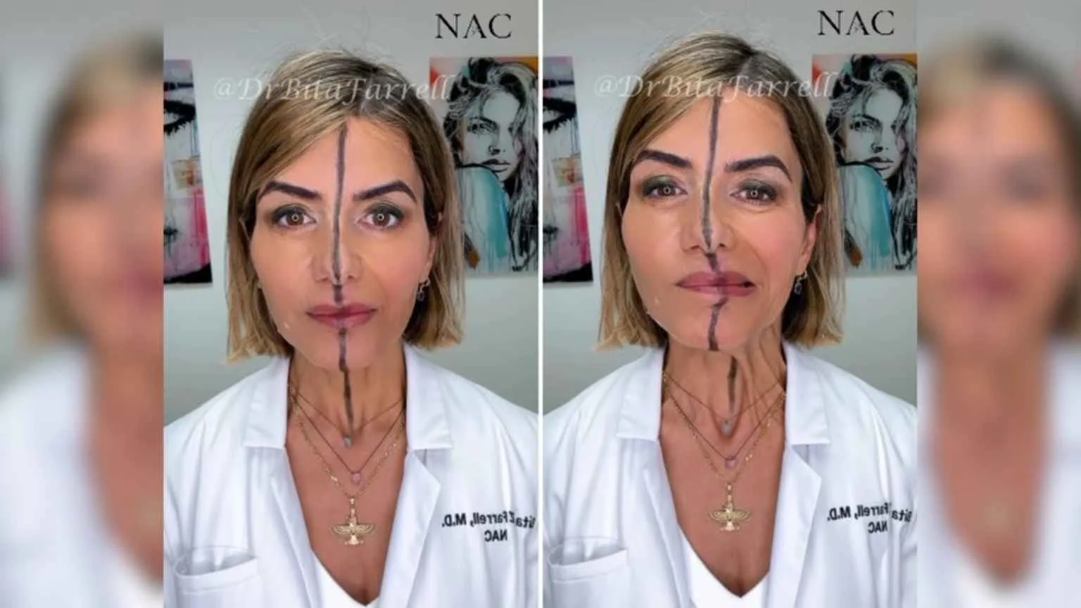 Médica aplica botox em apenas um lado do rosto e vídeo viraliza com resultado impressionante