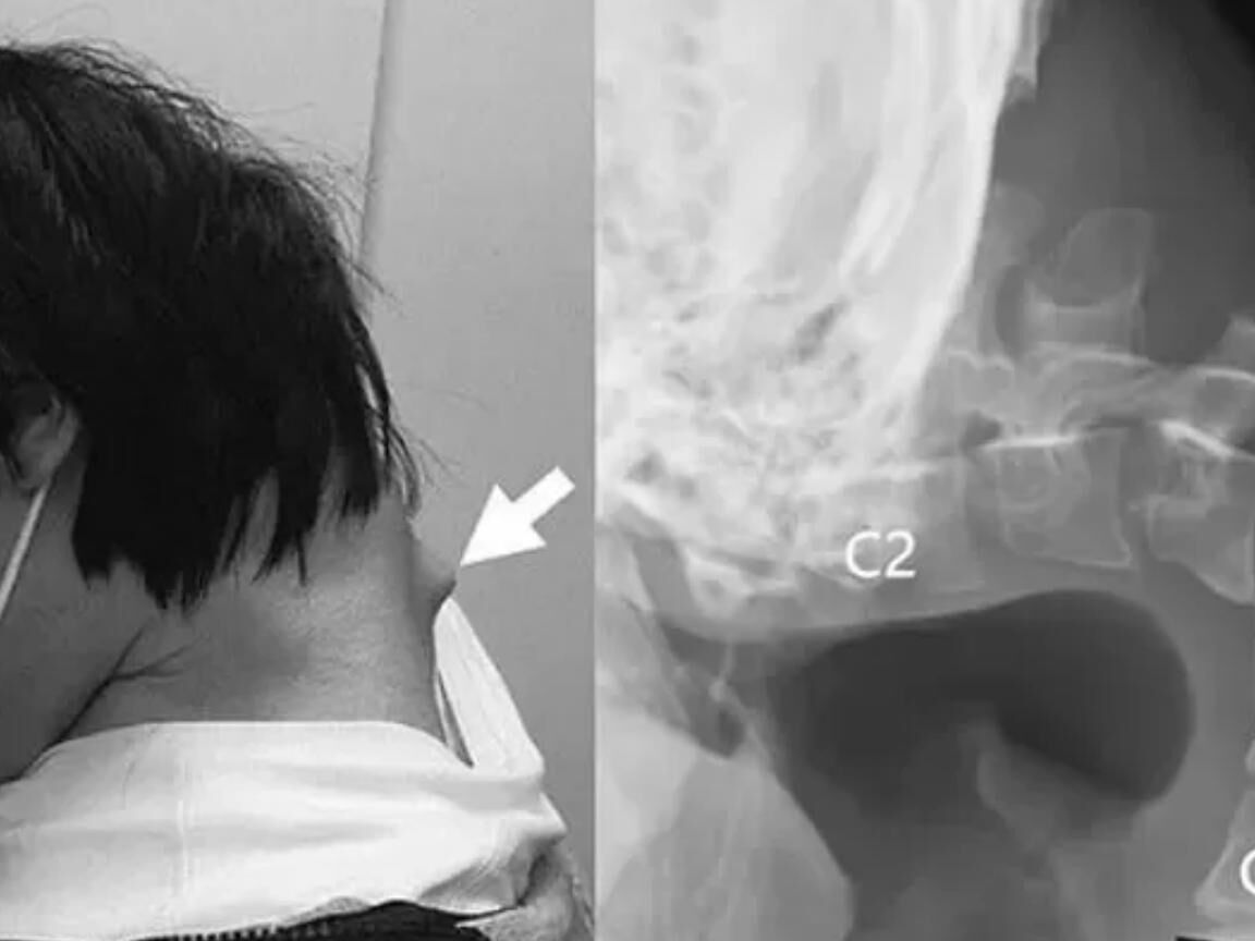 Síndrome da cabeça caída: o chocante caso do jovem japonês que passou tempo demais no celular