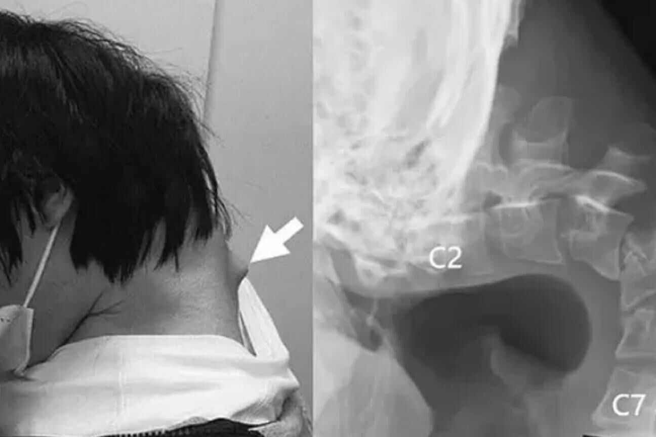 Síndrome da cabeça caída: o chocante caso do jovem japonês que passou tempo demais no celular