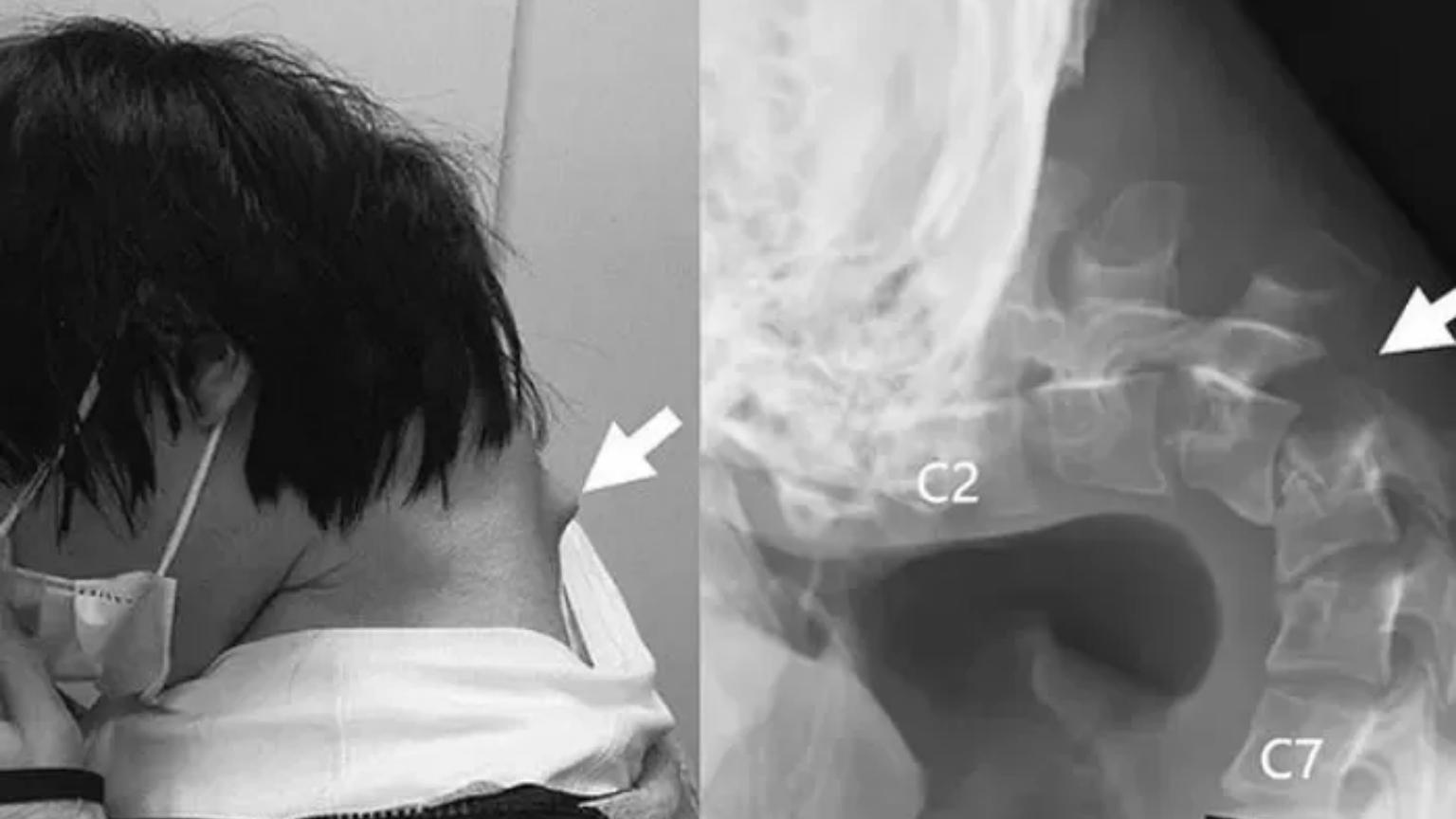 Síndrome da cabeça caída: o chocante caso do jovem japonês que passou tempo demais no celular