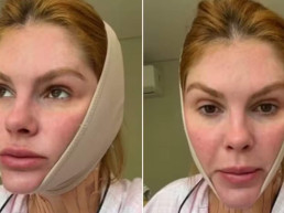 Bárbara Evans diverte seguidores ao mostrar perrengue com tratamento para papada: 'Eu sou um meme'