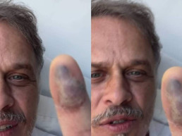 Recuperando-se de picada de jararaca, Guilherme Fontes brinca: 