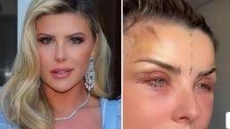 Iris Stefanelli, aos 45, revela plástica no rosto: 'Esperei 18 anos para criar coragem'