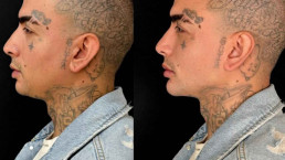 MC Guimê faz harmonização facial e mostra o resultado: 'O pai ficou mais bonito'