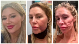Brandi Glanville revela perda de dentes e batalha para evitar 'derretimento' do rosto