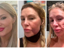 Brandi Glanville revela perda de dentes e batalha para evitar 'derretimento' do rosto