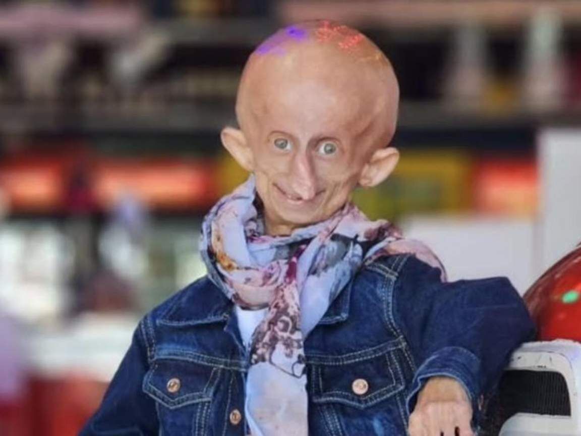 Influenciadora Beandri Booysen morre aos 19 anos devido à Progéria