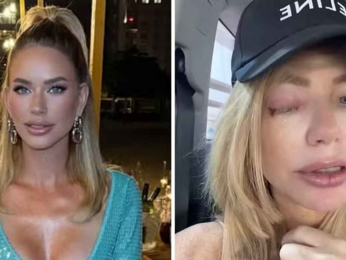 Estrela de reality é diagnosticada com 'olho explosivo' após infecção ocular severa
