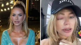 Estrela de reality é diagnosticada com 'olho explosivo' após infecção ocular severa