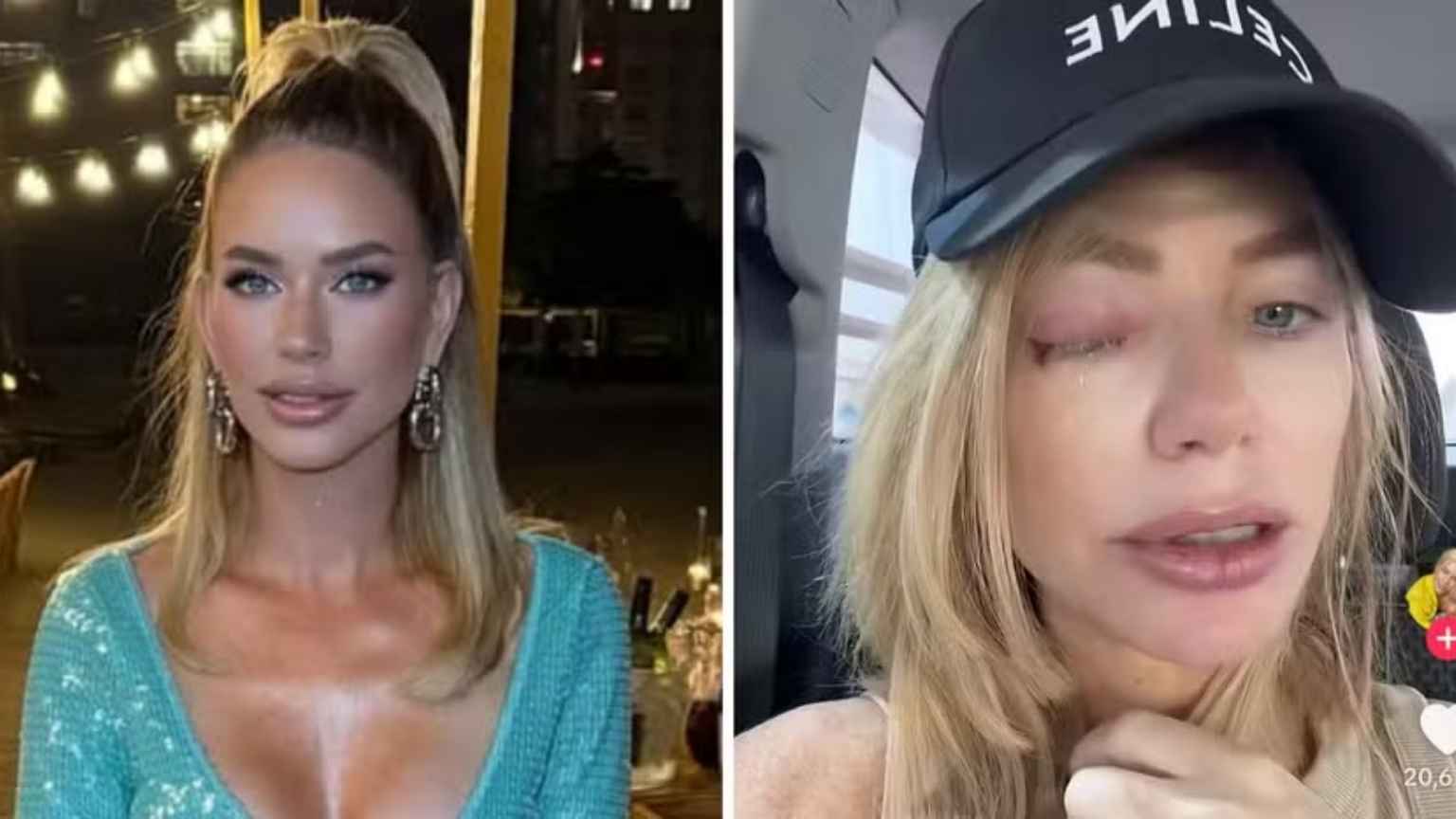 Estrela de reality é diagnosticada com 'olho explosivo' após infecção ocular severa