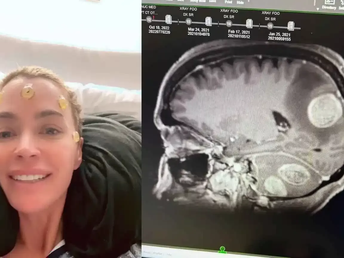 Teddi Mellencamp revela remoção de mais tumores cerebrais do que o esperado