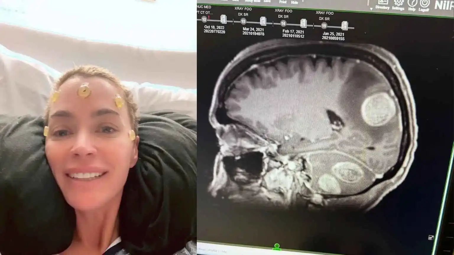 Teddi Mellencamp revela remoção de mais tumores cerebrais do que o esperado