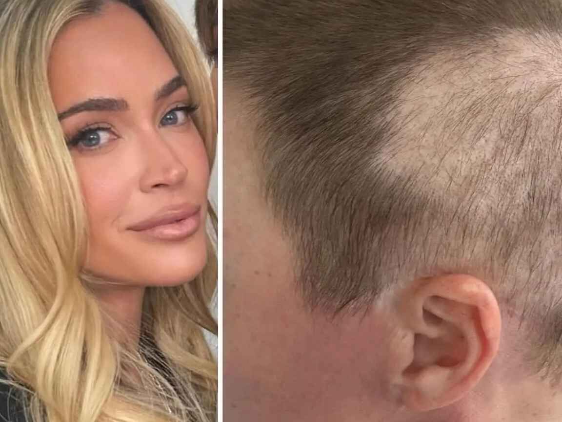 Teddi Mellencamp desabafa sobre solidão durante luta contra câncer em estágio 4