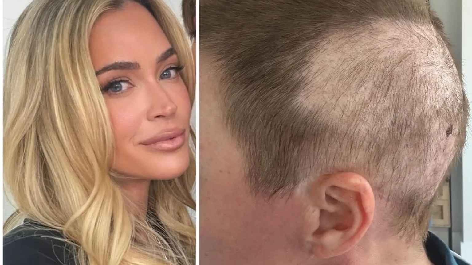 Teddi Mellencamp desabafa sobre solidão durante luta contra câncer em estágio 4