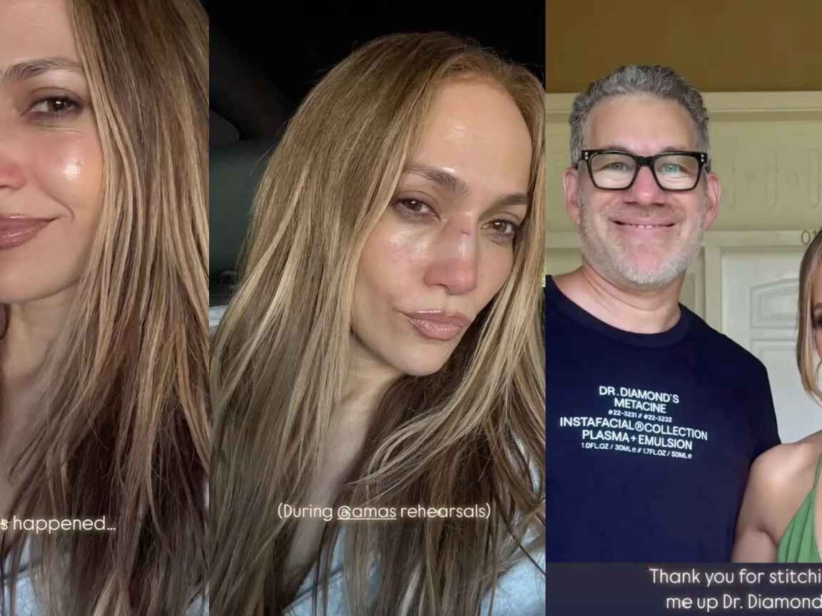 Jennifer Lopez leva pancada no rosto durante ensaio para o AMAs 2025 e compartilha fotos dos ferimentos