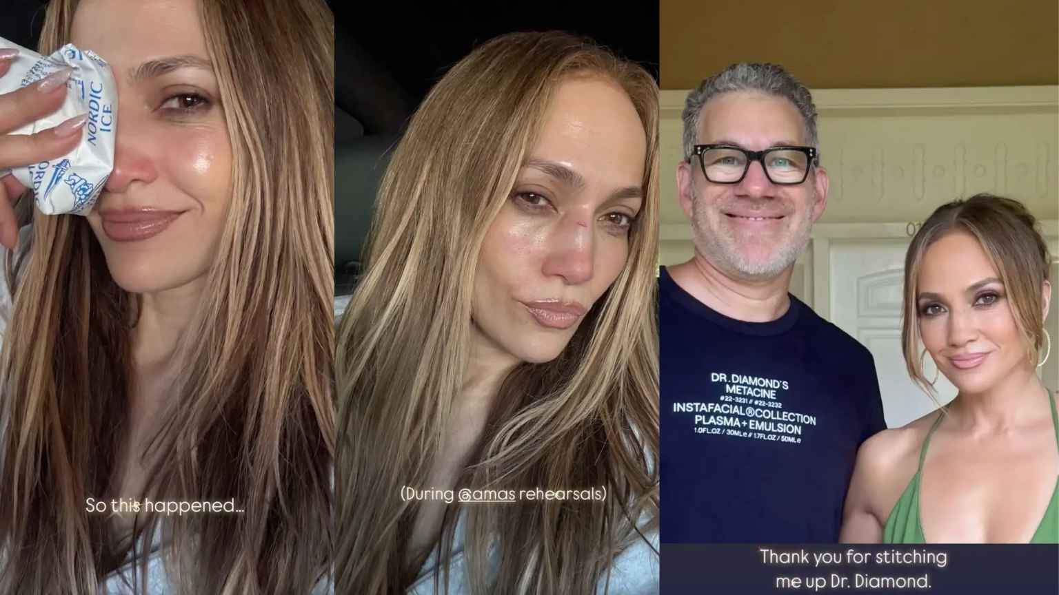 Jennifer Lopez leva pancada no rosto durante ensaio para o AMAs 2025 e compartilha fotos dos ferimentos