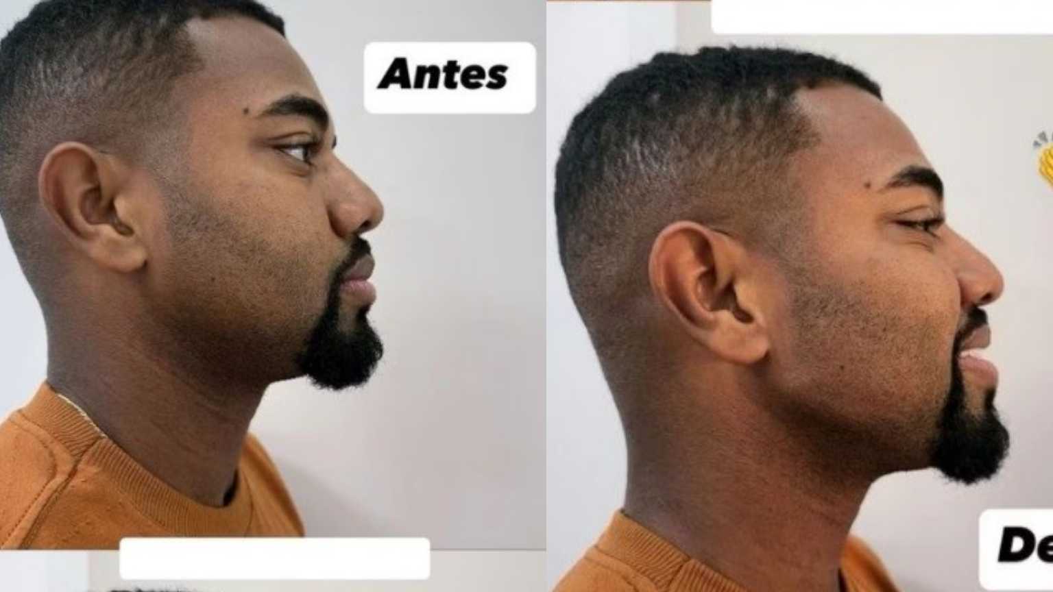 Davi Brito apresenta novo visual após lipo e até lente no dentes