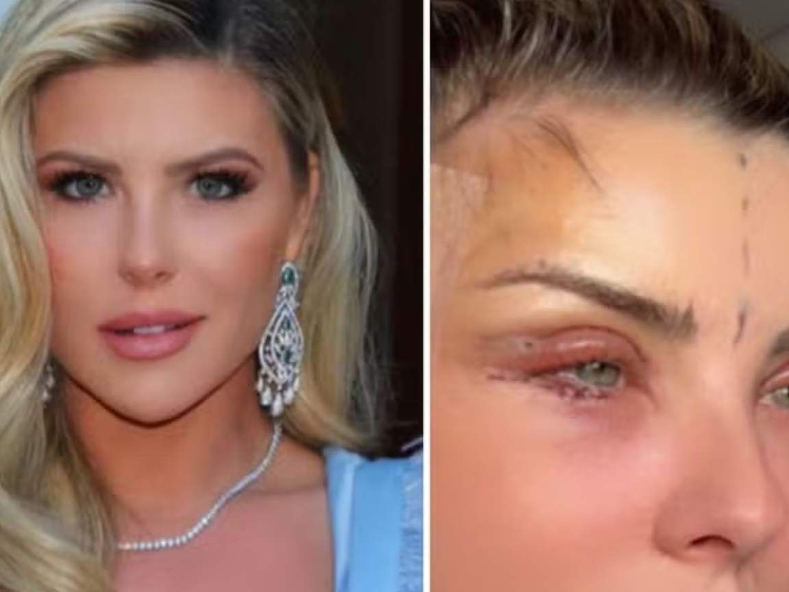 Iris Stefanelli, aos 45, revela plástica no rosto: 'Esperei 18 anos para criar coragem'
