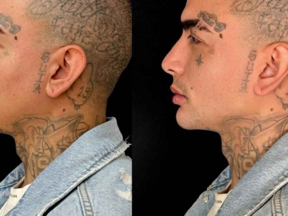 MC Guimê faz harmonização facial e mostra o resultado: 'O pai ficou mais bonito'