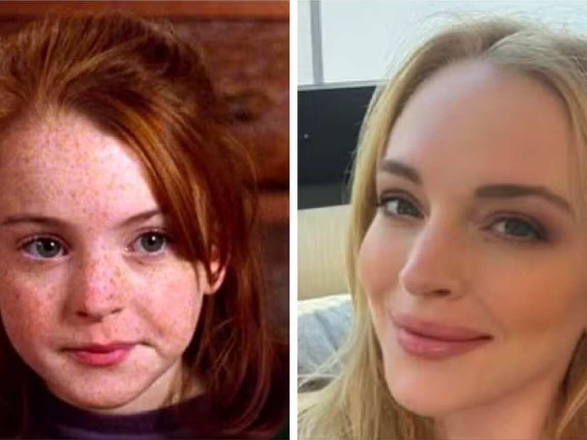 Sumiço das sardas de Lindsay Lohan é explicado por relação com dermatologista, diz jornal