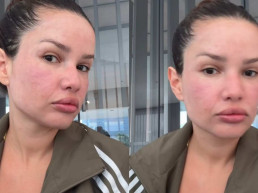 Juliette faz procedimento com 'esperma de salmão' e brinca com inchaço: 'Igual um baiacu'