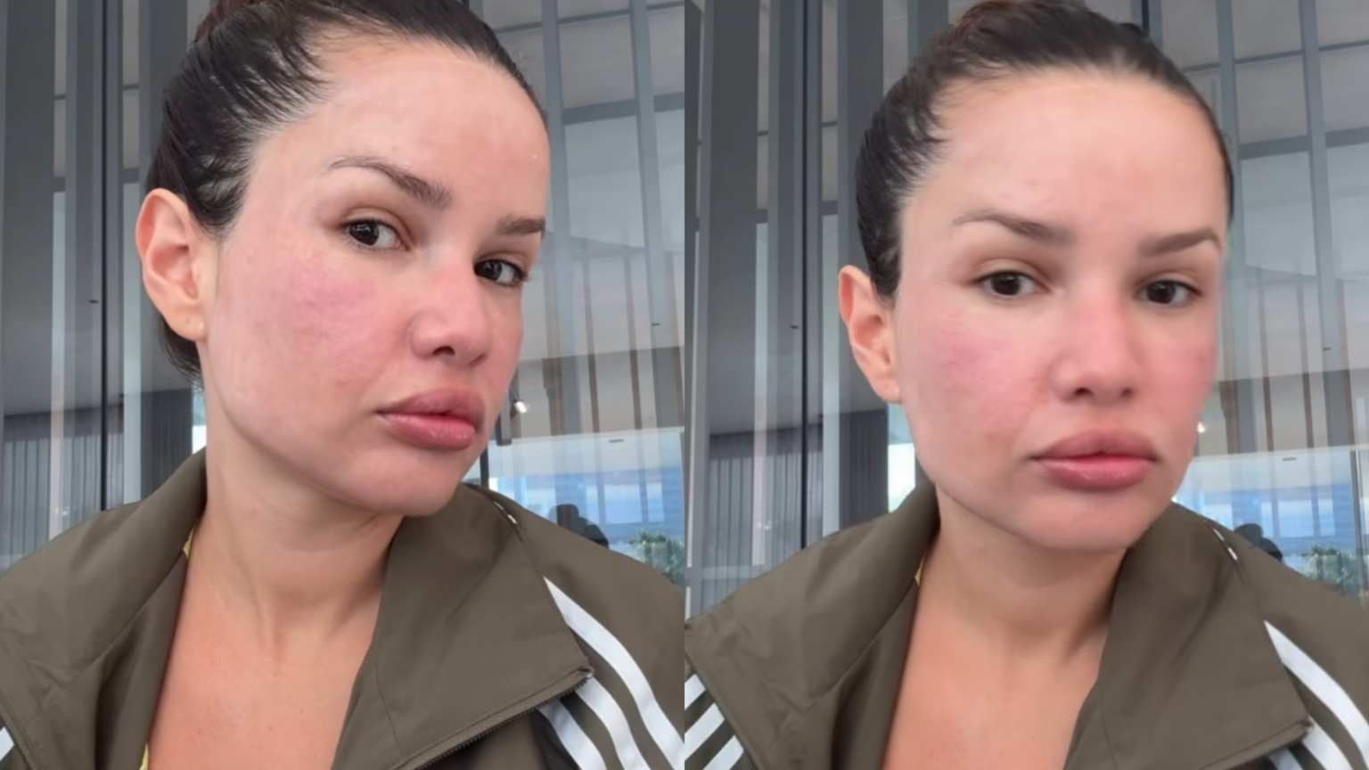 Juliette faz procedimento com 'esperma de salmão' e brinca com inchaço: 'Igual um baiacu'