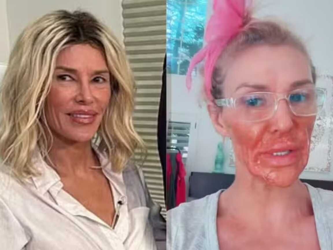 Brandi Glanville mostra 'novo rosto' e revela tratamento com especialista após queimaduras