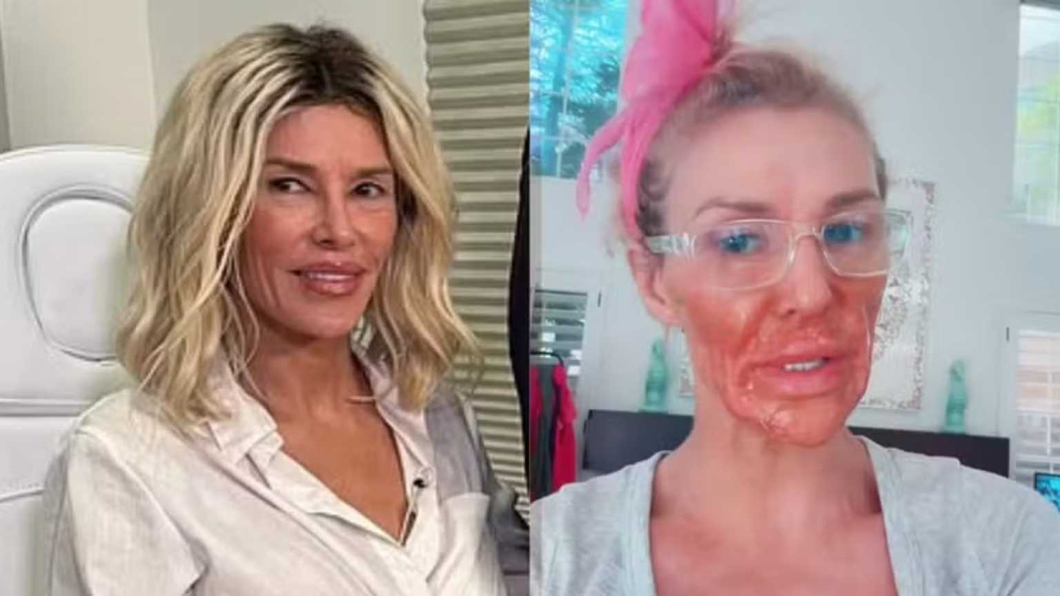 Brandi Glanville mostra 'novo rosto' e revela tratamento com especialista após queimaduras
