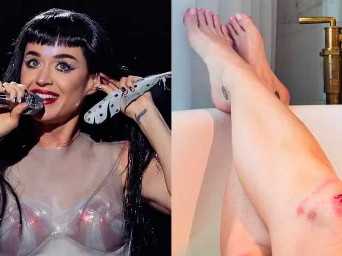 Katy Perry exibe joelhos machucados após fã desmaiar em seu palco