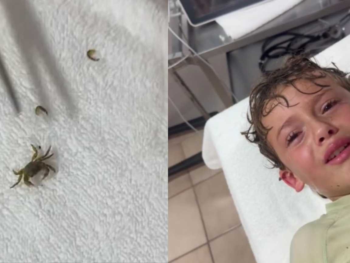 Menino tem caranguejo vivo retirado do ouvido e vídeo do resgate viraliza
